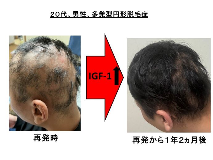 円形脱毛症　病院